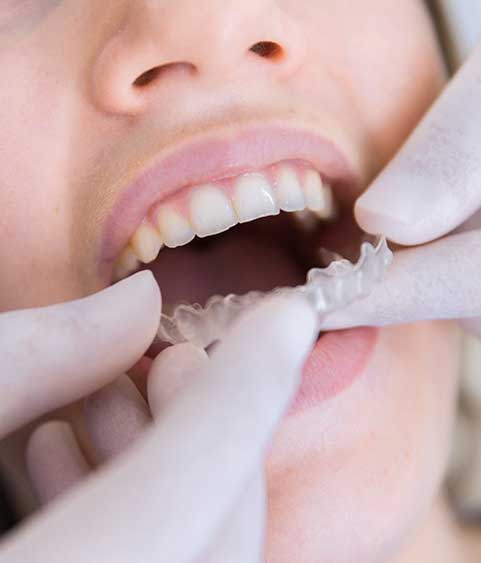 ortodondia-invisible-markina